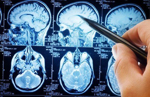 liečba nádorov mozgu magnetická rezonancia