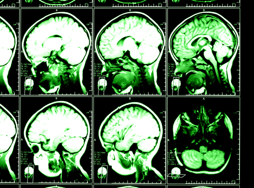 neuropsychiatria MRI mozog