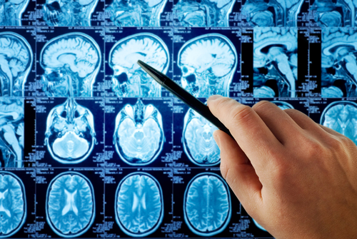 tras Parkinsonova choroba hlboká mozgová stimulácia