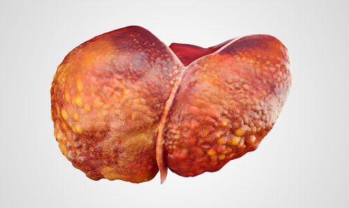 Májové hepatologické dni 2016 cirhóza pečene