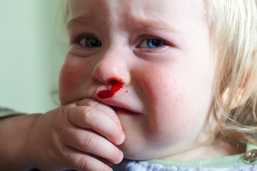 krvácanie z nosa u malých detí