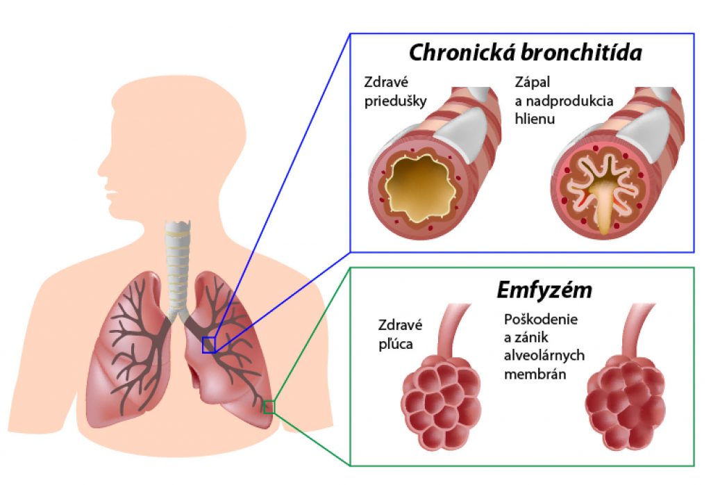 chronicka-bronchitida-emfyzem
