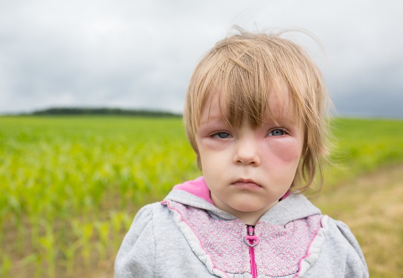 alergia-u-detí-príznaky-prejavy