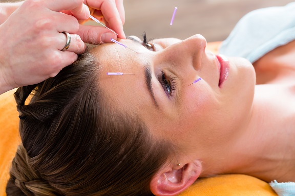 akupunktúra-na-migreny