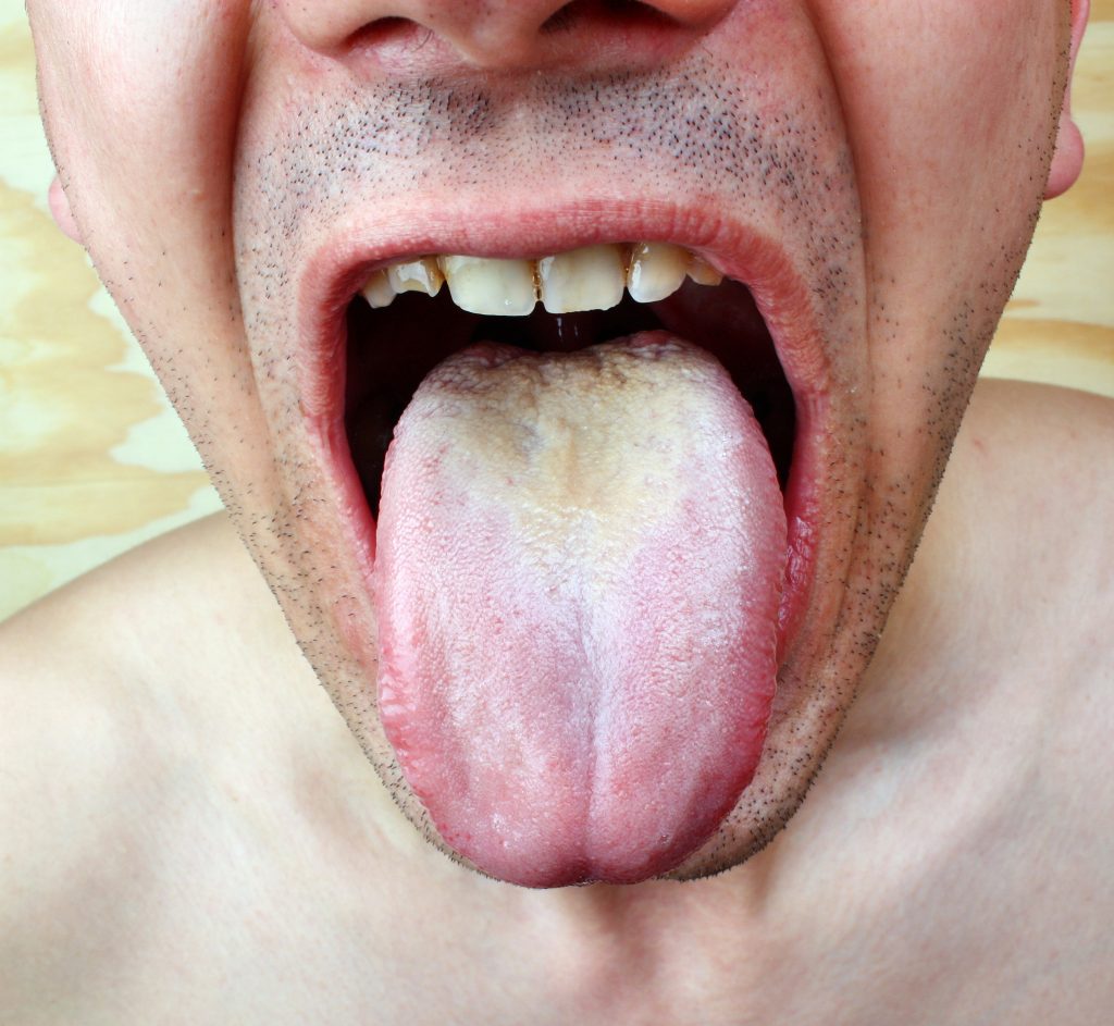 infekcia na jazyku