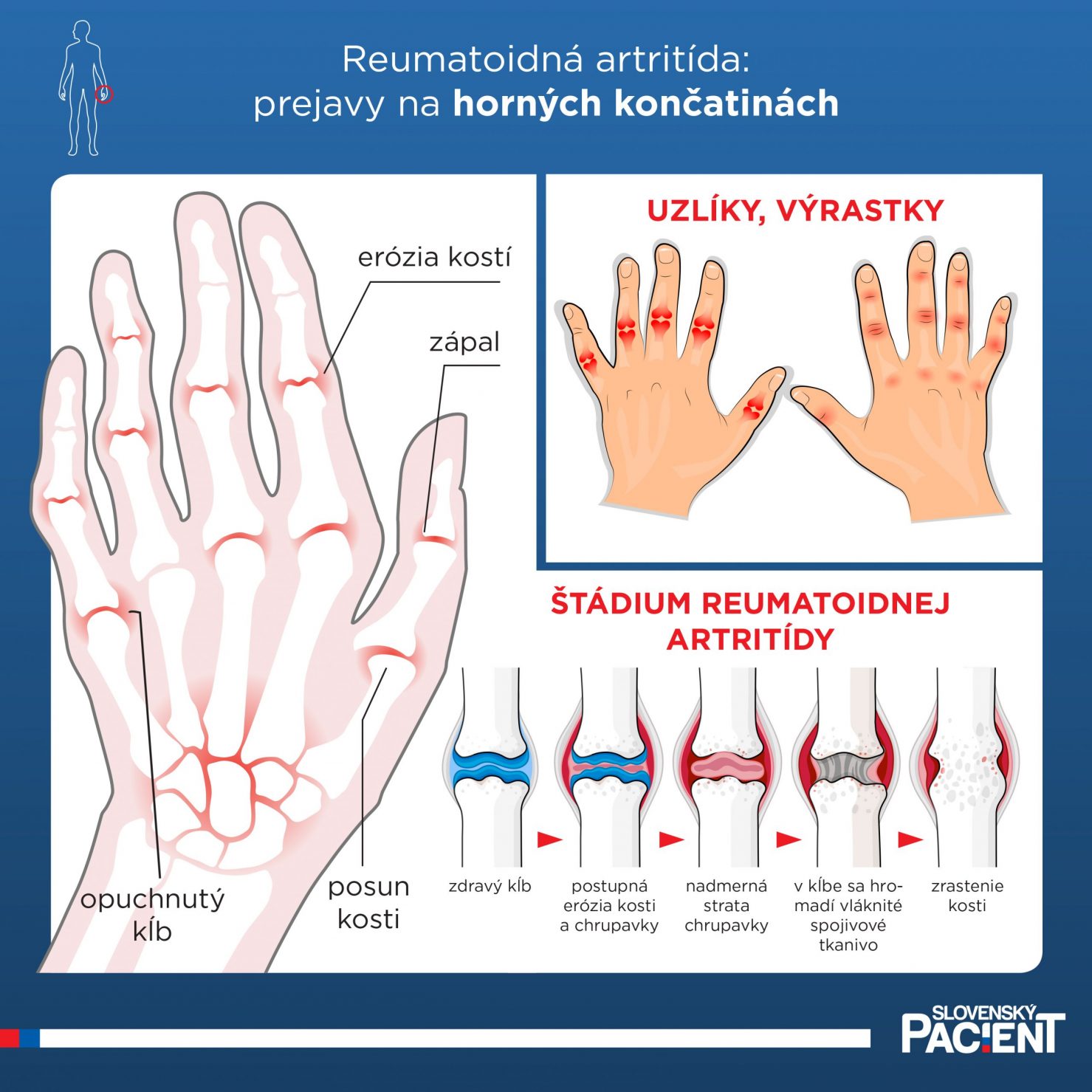Prejavy reumatoidnej artrídy