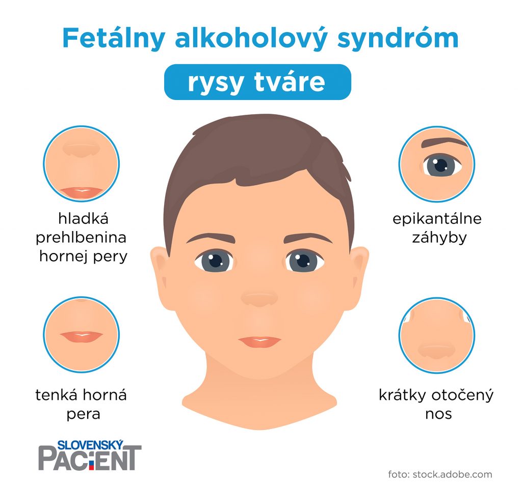 Fetálny alkoholový syndróm - Rysy tváre