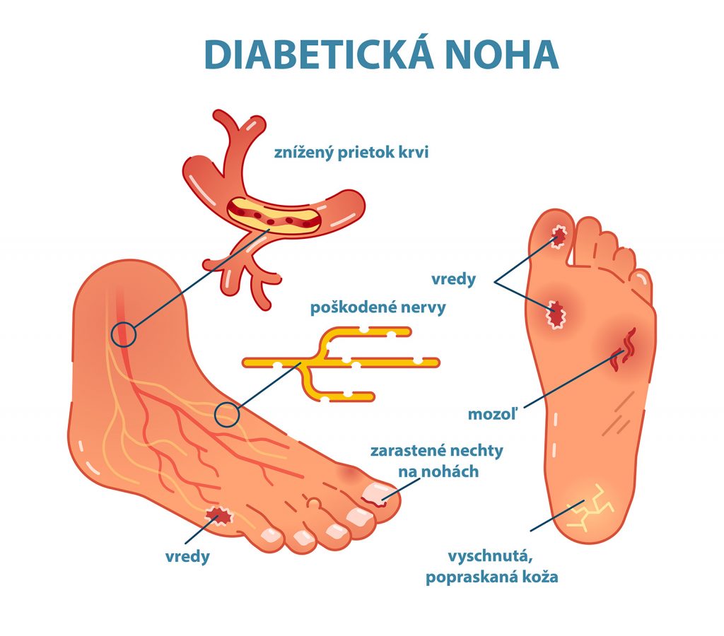 Infografika diabetická noha