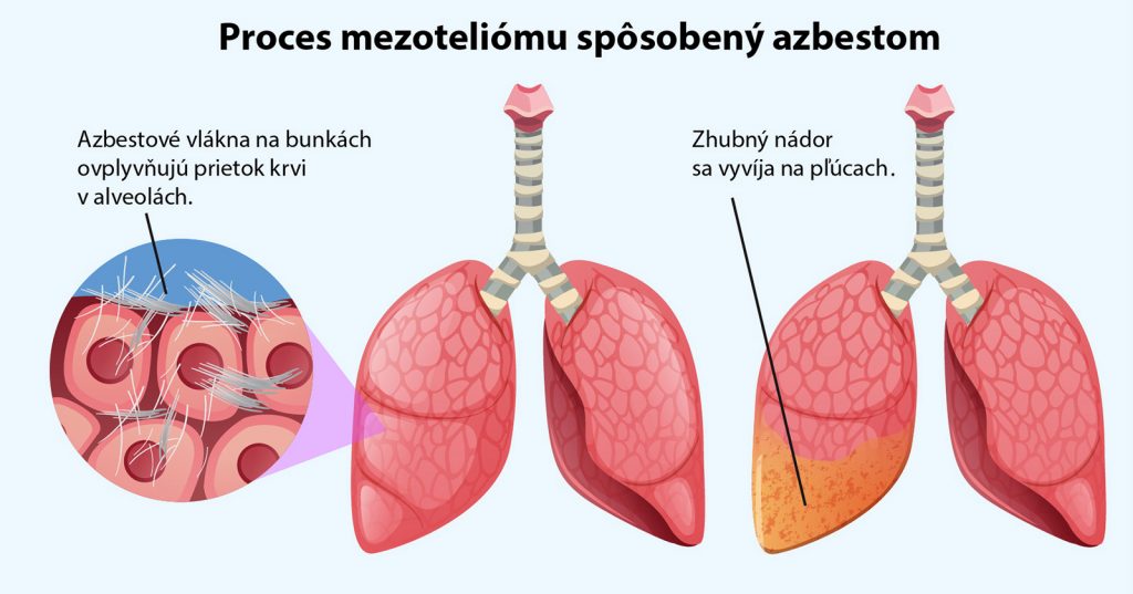 Proces mezoteliómu spôsobený azbestom