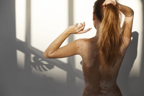 žena s vitiligom na chrbte a ramenách 